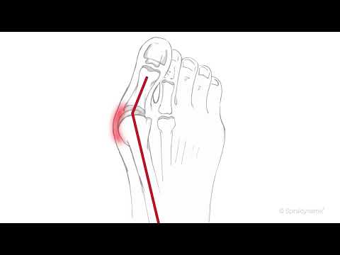 Hallux Valgus einfach erklärt