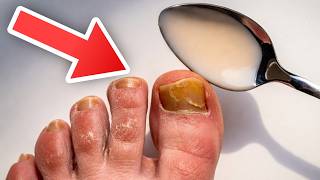 Use THIS to remove Athlete's foot & Nail fungus  💥 (Incredibly Fast)