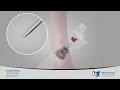 FNA & FNB EUS Needles from Micro-Tech Endoscopy