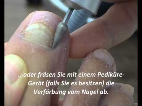 Von gribka auf den Beinen kanespor die Rezensionen Lamisil die Anwendung bei gribke der Nägel