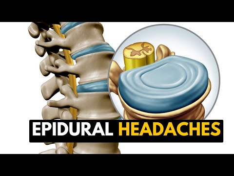 Brain Aneurysm Causes Signs and Symptoms Diagnosis and Treatment