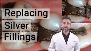 REPLACING SILVER FILLINGS OR AMALGAM FILLINGS- BIOMIMETIC DENTISTRY