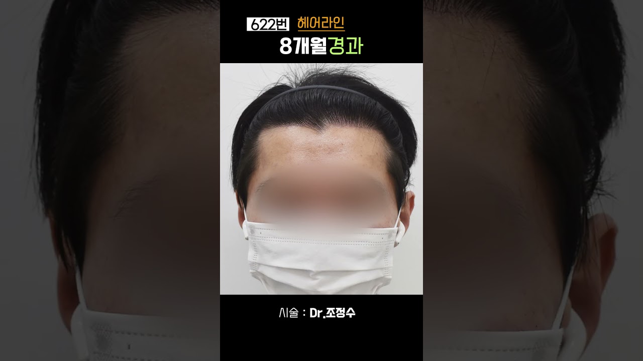 622번 비절개 헤어라인 모발이식 1500모 조정수 원장님 모바른 #모바른