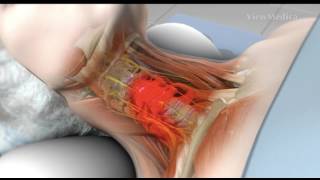 ARTRODESIS CERVICAL Y DISCECTOMIA