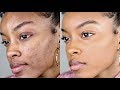 How To Cover Acne/dark Spots WITHOUT A Lot Of Makeup | Slim Reshae