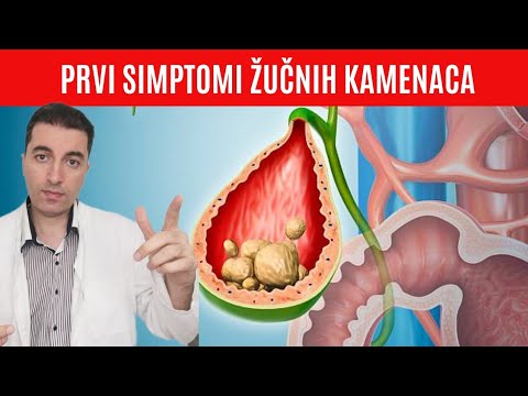 Prvi jasni simptomi i znakovi ŽUČNIH KAMENACA