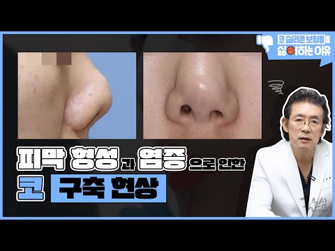 사례와 함께 보는 "내가 코 실리콘 보형물을 싫어하는 이유" #3 #구축코 #코보형물제거 #코재수술