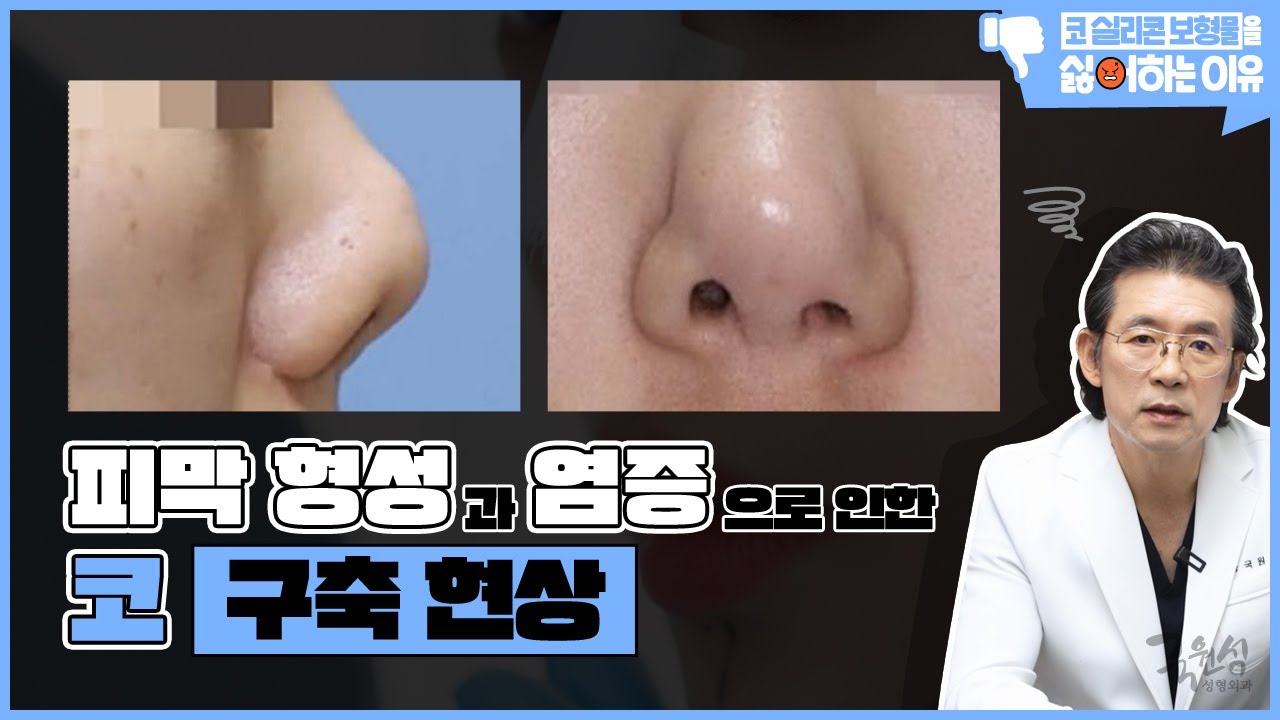 사례와 함께 보는 "내가 코 실리콘 보형물을 싫어하는 이유" #3 #구축코 #코보형물제거 #코재수술 썸네일