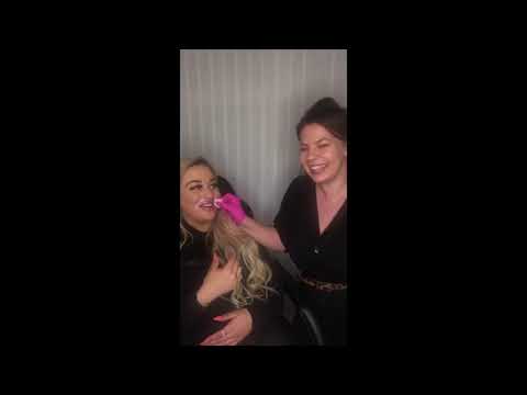 Nasolabial Fold Dermal Filler