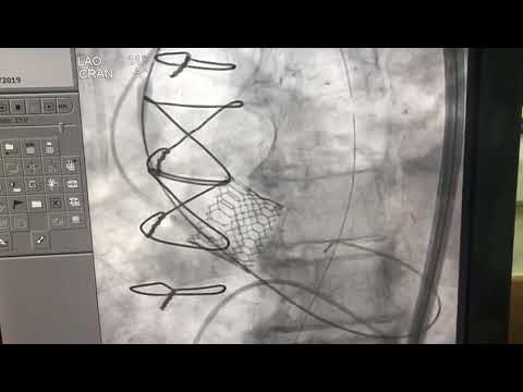 TAVR. Severe Aortic Stenosis. Sapien 3
