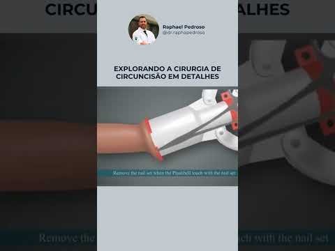 Em uma animação 3D muito interessante, podemos ver os detalhes da cirurgia de circuncisão.