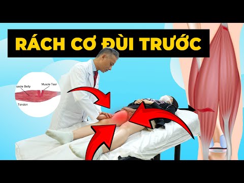 Bạn Bị Rách Cơ Đùi Trước? Điều Trị Ngay Trước Khi Quá Muộn!