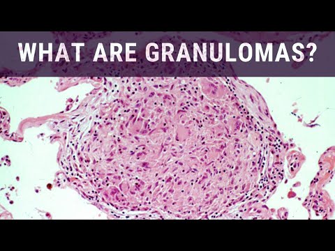 What are Granulomas? - Pathology mini tutorial