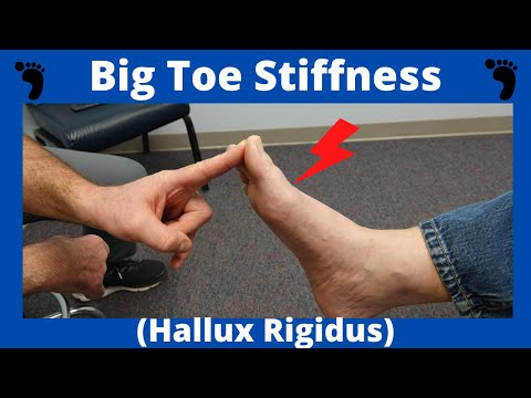 Stiff Big Toe Joint (Hallux Rigidus) Treatment