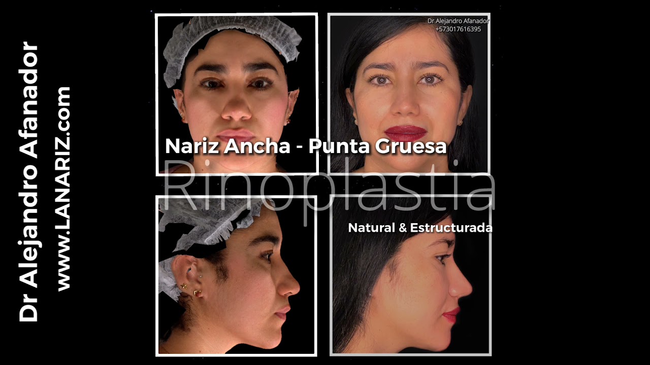 Watch Nariz ancha y gruesa RINOPLASTIA PUNTA NASAL Now Nariz ancha y gruesa RINOPLASTIA PUNTA NASAL