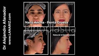 Nariz ancha y gruesa RINOPLASTIA PUNTA NASAL
