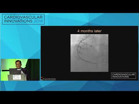 CVI2018 Session: Device entrapment during retrograde CTO PCI - Minh Vo, MD