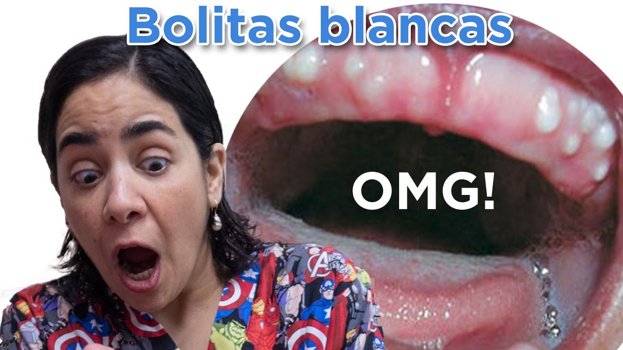 Bolitas blancas en la encía: ¿ES MALO