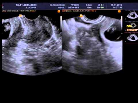 Ultrassom 8 semanas e 4 dias