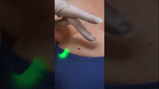 Download lagu Bye-bye Cherry Angiomas! ✨🔴 mp3