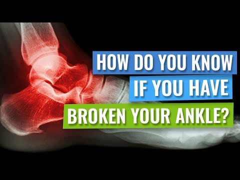 How Do you Know Whether you Have Broken your Ankle?