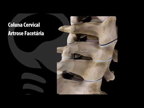 Artrose Facetária Cervical