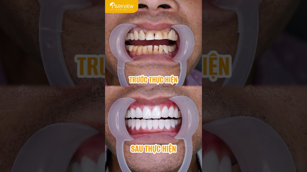 Răng Ố Vàng, Thưa Kẽ, Lung Lay – Giải Pháp Phục Hồi Ăn Nhai Chắc Chắn & Thẩm Mỹ Tại Parkview Dental