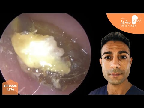 1,274 - Every Year Completely Blocked Ear Wax Removal