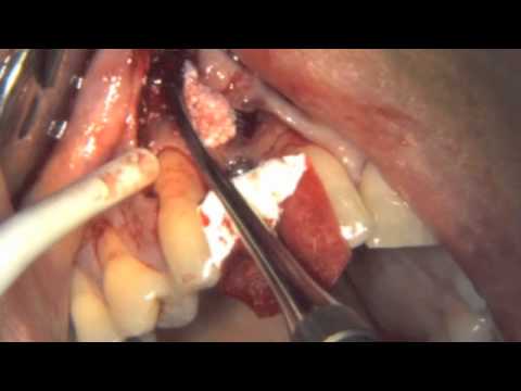 Implant Placement With Simultaneous Bone Augmentation - Case 1