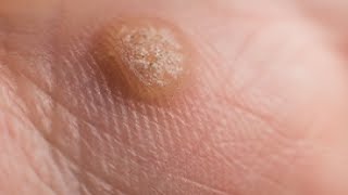 how to get rid of warts on fingers in a day