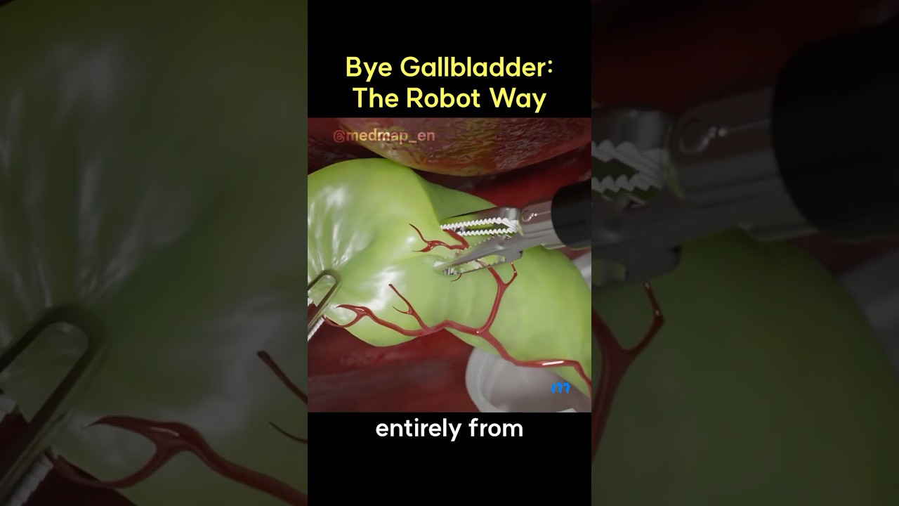 Bye Gallbladder: The Robot Way