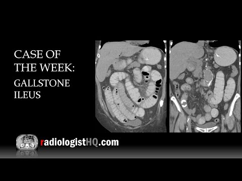 Case of the Week: Gallstone Ileus (X-ray & CT)