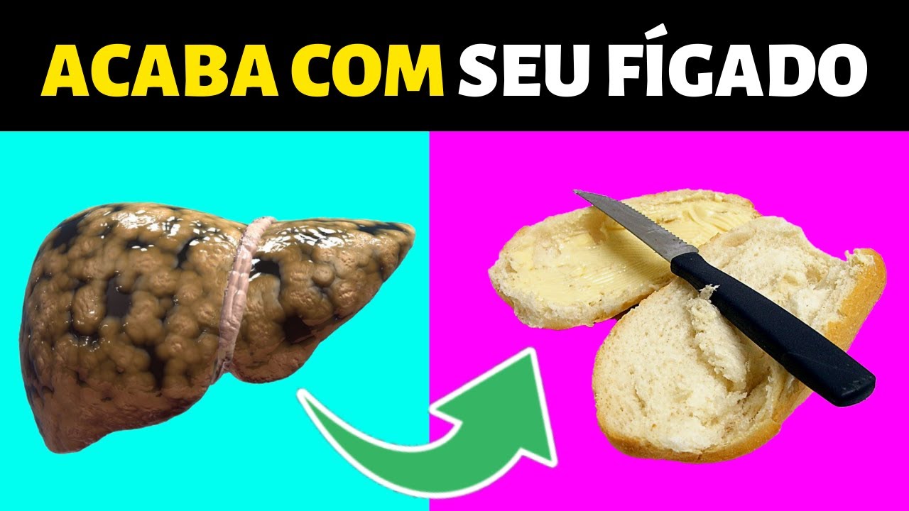 7 SINAIS DE GORDURA NO FÍGADO (ESTEATOSE) - COMO EVITAR