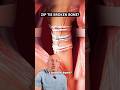 Fixing Broken Bones Cerclage Fracture Repair Shorts