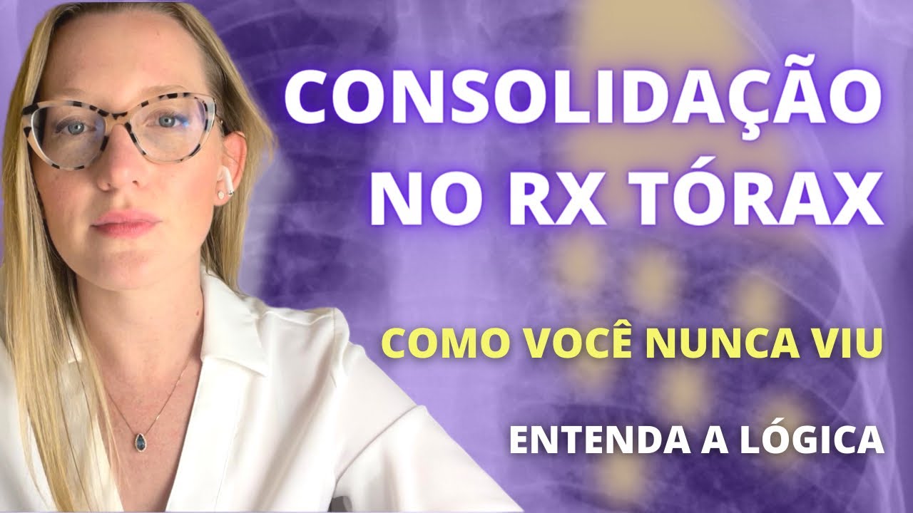 Consolidação no Rx de tórax! Broncopneumonia, pneumonia lobar…