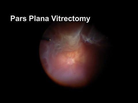 Scleral Buckle with Pars Plana Vitrectomy for Retinal Detachment with Multiple Tears 