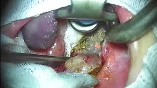 La reducción de amígdalas con tratamiento láser