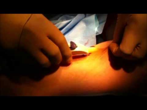 comment poser implanon