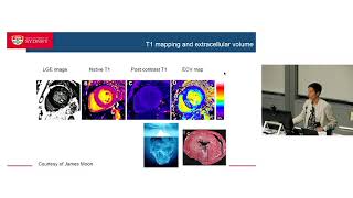 Left Ventricular Fibrosis – Prof Gemma Figtree