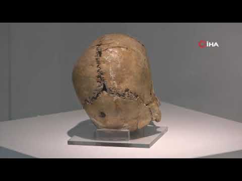 İşte dünyanın ilk beyin ameliyatına ait kafatası