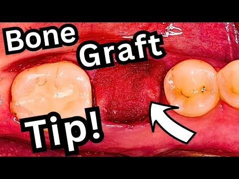 Tip for Simple Bone Graft Suturing | Socket Preservation