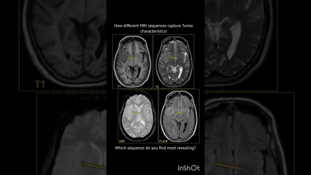 How different MRI sequences highlight tumor characteristics!