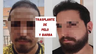 CASO REAL: TRASPLANTE DE BARBA Y DE PELO EN LA MISMA OPERACIÓN