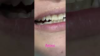 ANTES Y DESPUES PACIENTE  #dentista #belleza #salud #orthodentic