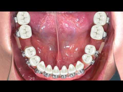 To cut the mainwire or not, that is the question.｜【Chris Chang Ortho】CC488