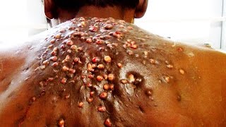Worst Back Cysts &amp; Lesions!  Real or Fake?