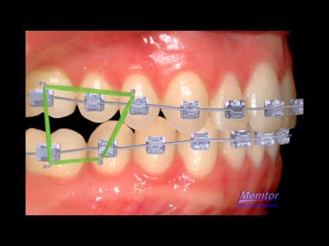 Rubber band to correct posterior open bite-orthodontist