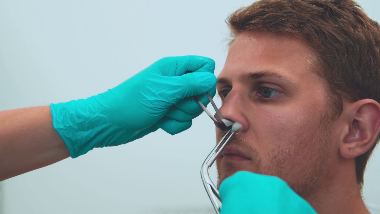 The Management of Epistaxis