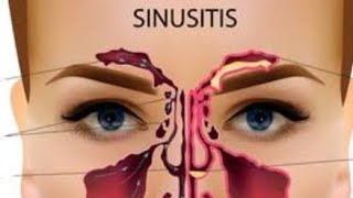 How to cure sinusitis with excercise || साइनस की आसान और इफेक्टिव excercise #💯रिजल्ट