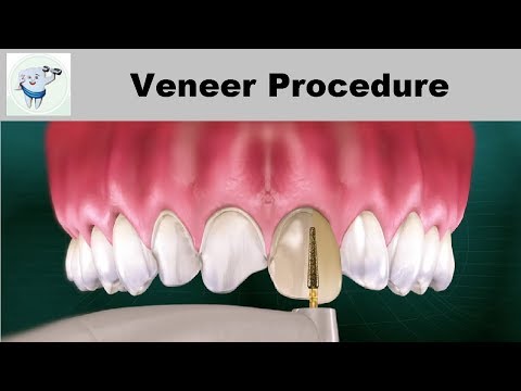 Veneer